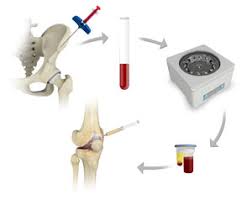 Joint replacement surgery