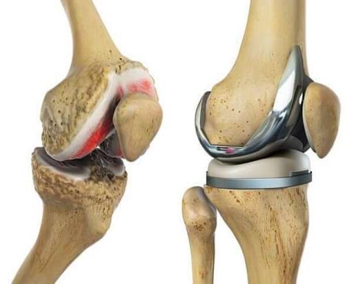 Robotic knee replacement surgery