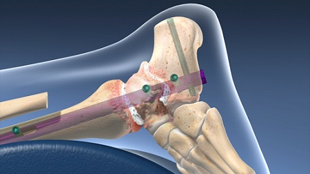Robotic knee replacement surgery