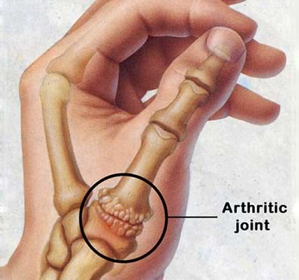 Best Hospital for Arthritis in Patna