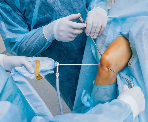 Arthroscopy Surgery in India