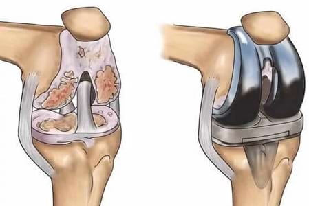 Total Joint Replacement