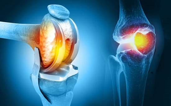 Joint replacement surgery