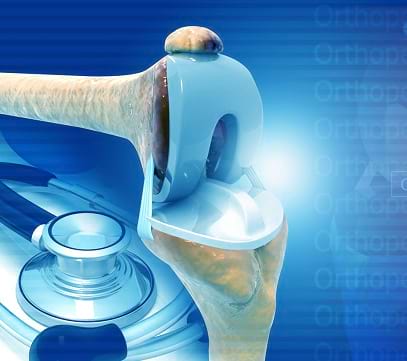 Robotic knee replacement surgery