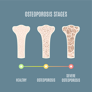 osteoporosis surgery
