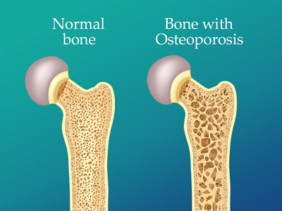 Osteoporosis surgery in Bihar
