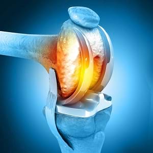 Robotic knee replacement center in Bihar