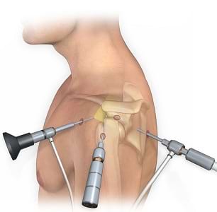 Robotic joint replacement